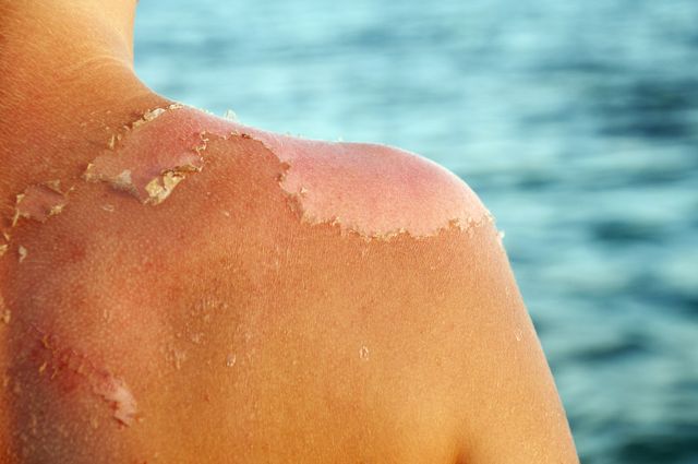 How to get rid of a sunburn fast?