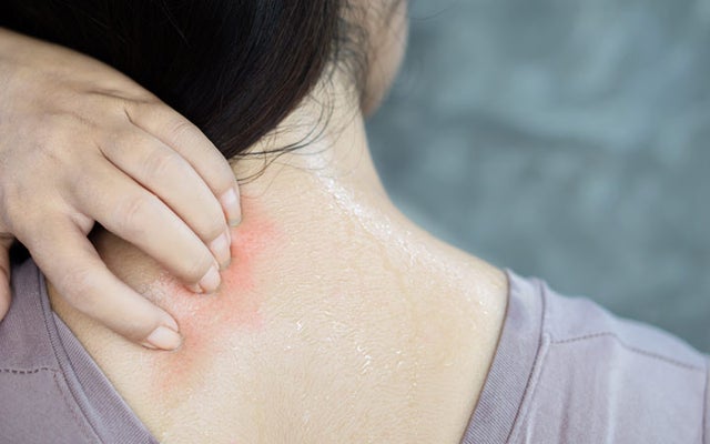 How to treat heat rash?